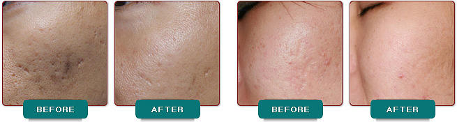 Acne Treatment Houston - Skin 101 Medical Spa Houston