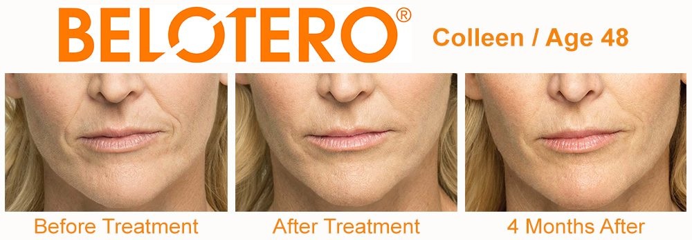 Belotero Before and After in Houston Skin 101