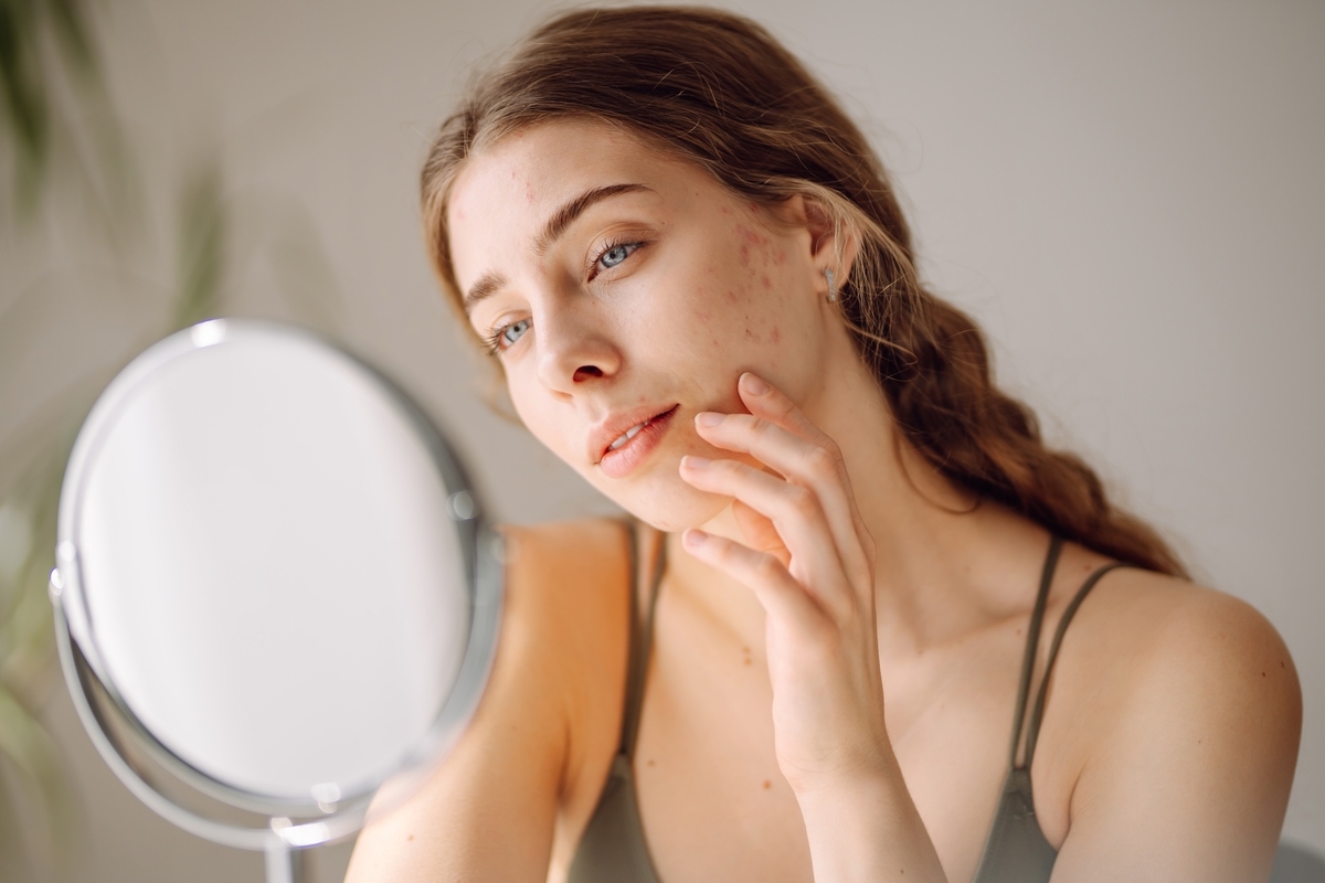 Woman examining acne scars on her cheek before starting acne scar treatment