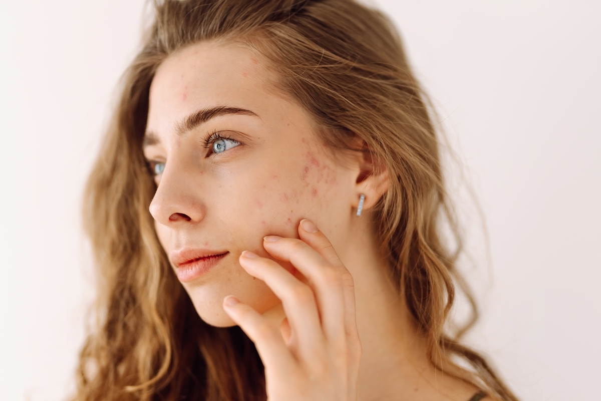 Woman with acne scarring on her cheek considering acne scar treatment in Houston