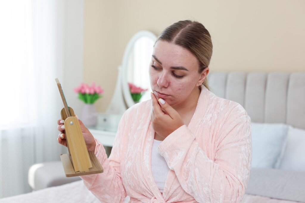 Woman examining acne scars in a mirror wondering if microneedling for acne scars works